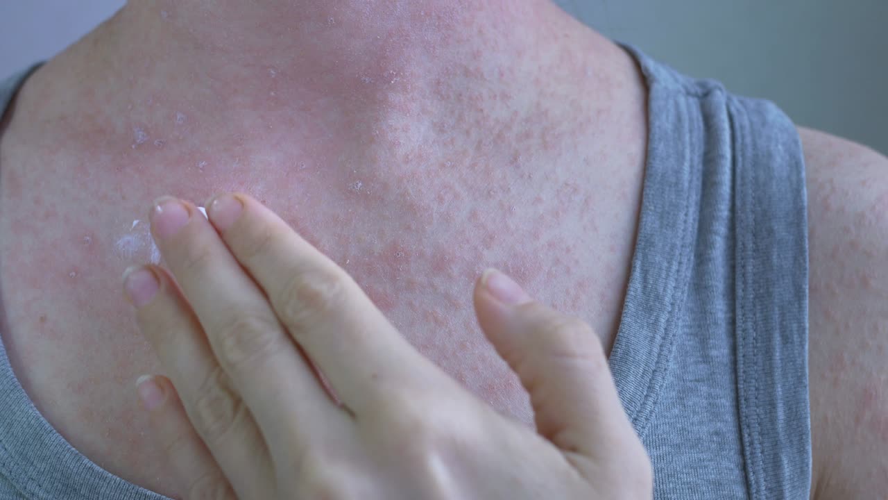 el primer plano muestra las áreas afectadas de la piel con granos rojos claros. hay ungüento blanco en el dedo. el cuerpo lleva una camiseta gris. enfermedades virales. picazón en la piel