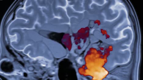 mri scans highlighting brain structure and anatomy, focusing on coronal views to illustrate internal features and organization of neural tissue
