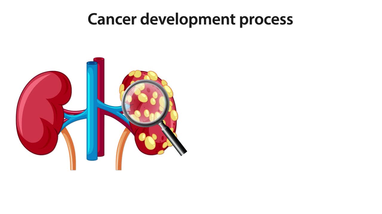 Medical animation illustrating kidney cancer progression, showing tumor growth, cellular transformation, and cancer cell doubling with clear diagrams and labeled transitions