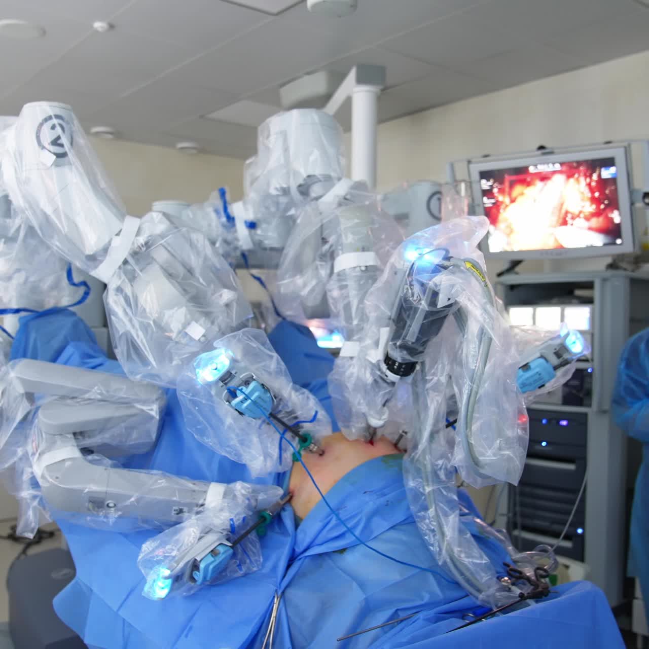 Medical hospital staff came to watch the operation conducted by a technological high-precise robotic equipment. Screen showing inner organ at backdrop