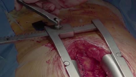 heart surgery installation of a retractor close-up