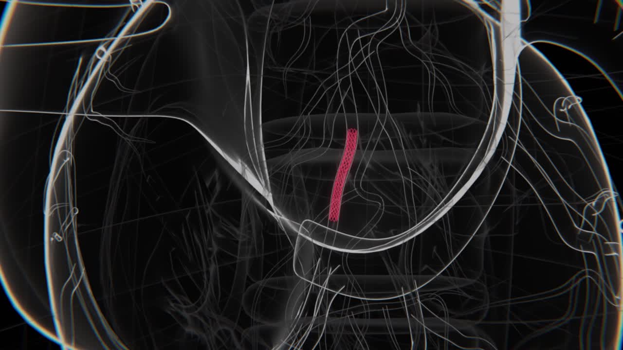 Illustrazione medica 3D di posizionamento di stent coronarico | Video di stent coronarico | Video di stent arterioso | Video radiografico in HD