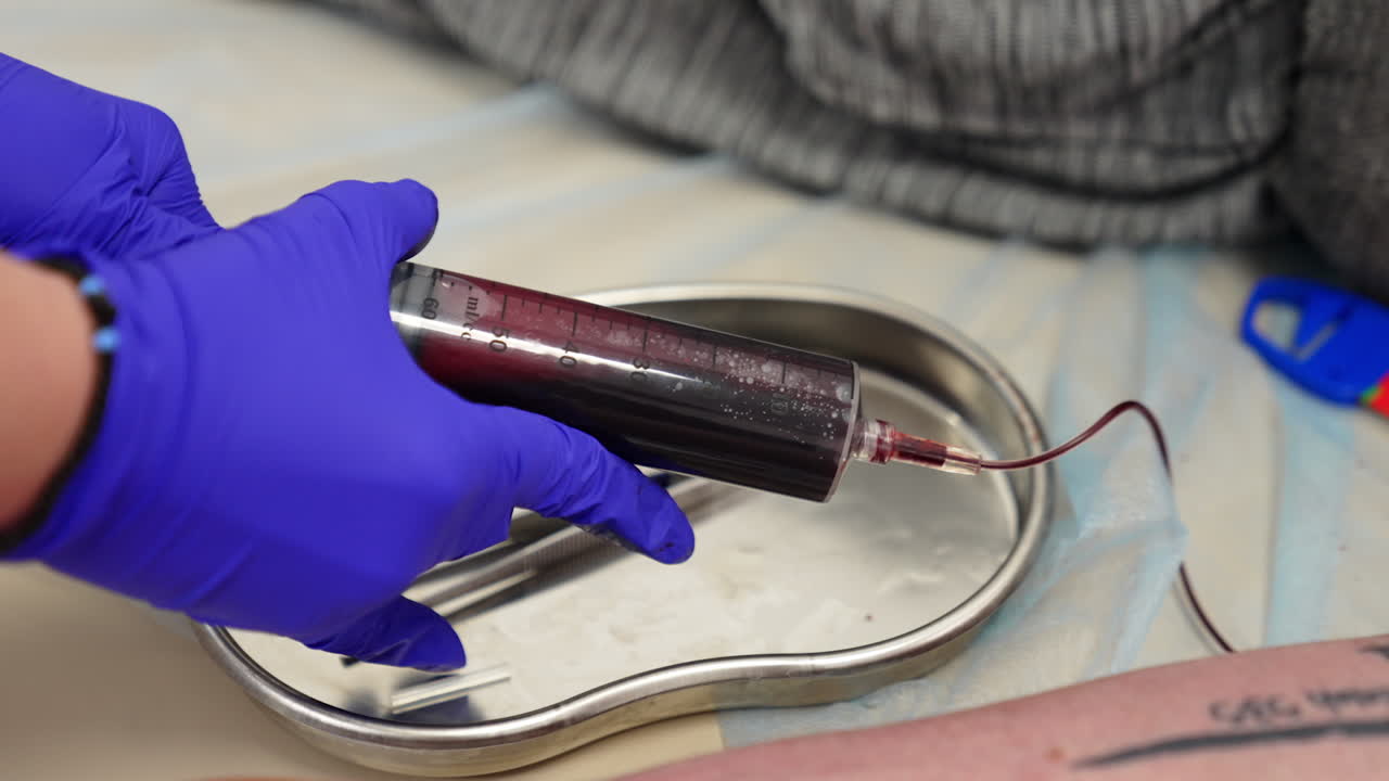 Gloved hands hold a syringe filled with blood. Blood sampling. Extraction of plasma. Close up.