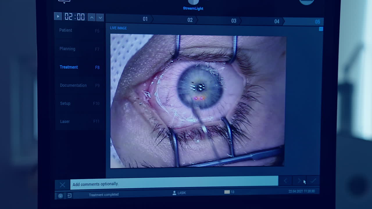 Patient during ophthalmic surgery. Doctor with equipment removes the cyst in the eye