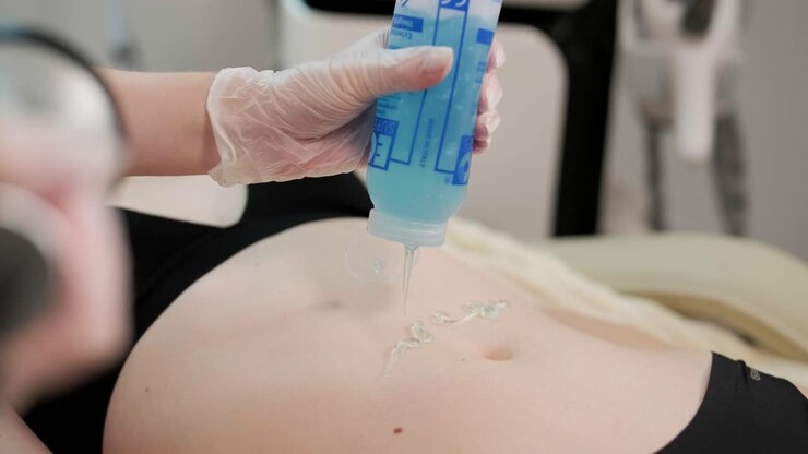 Procedura di lifting RF corpo. Donna che riceve terapia anticellulite e anti-adipe.