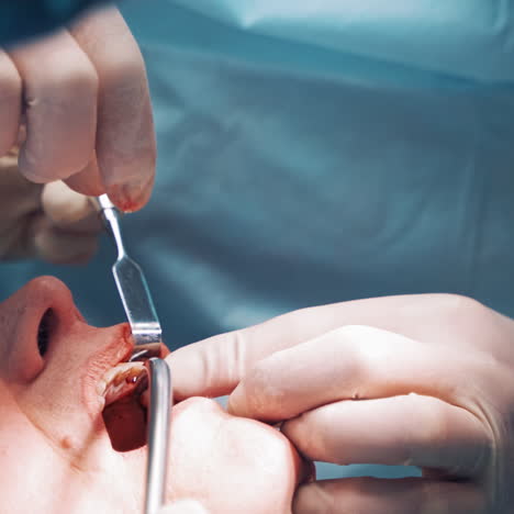 dentist's hands inserts metal pin to the patient's mouth in clinic. stomatologist and a nurse doing dental operation in the hospital. close-up. oral surgary.
