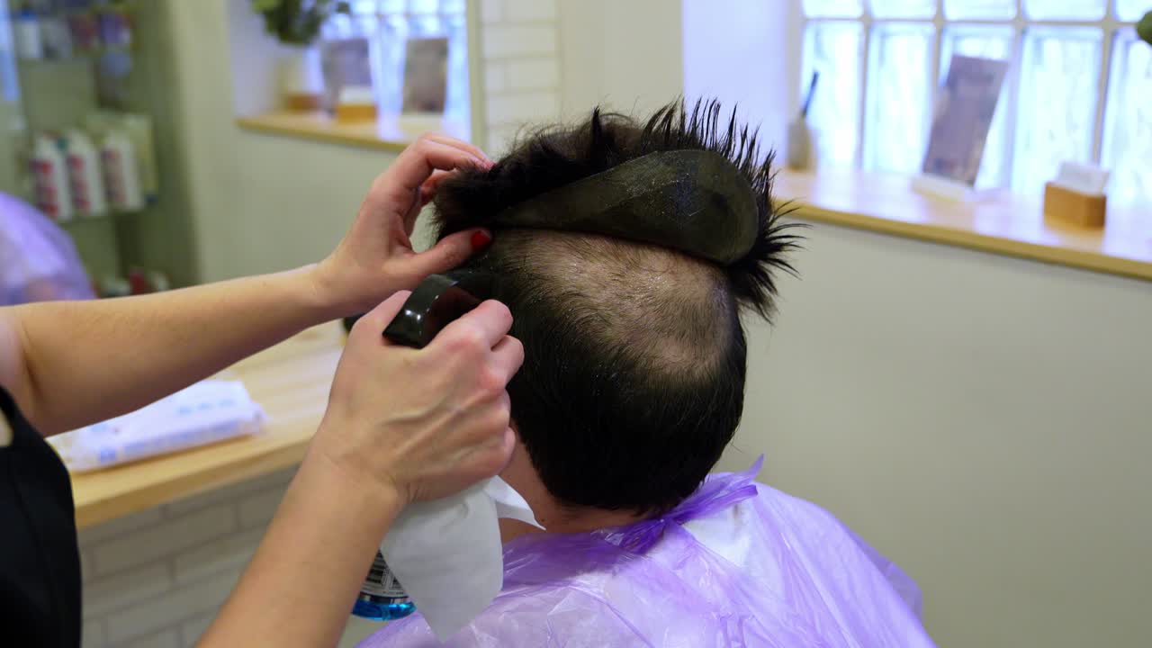 Procedimento di trapianto di capelli