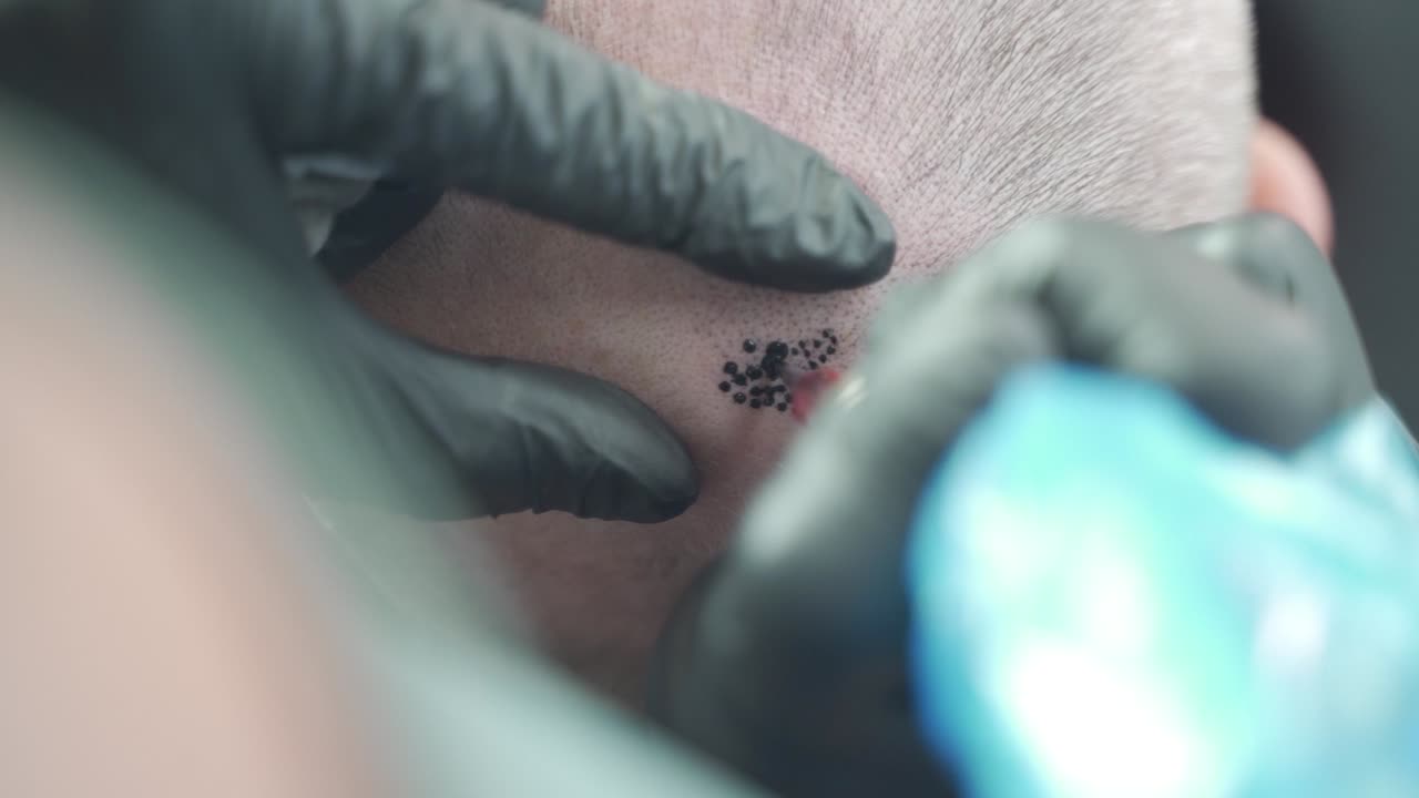 미세 색소 침착 치료중인 남자