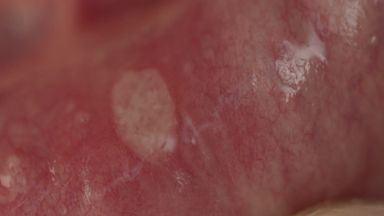 구강의 손상에 대한 매크로  ⁇ 은 aphthous stomatitis 또는 canker sores라고합니다.