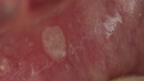 macro shot of a injury in the mouth called aphthous stomatitis or canker sores