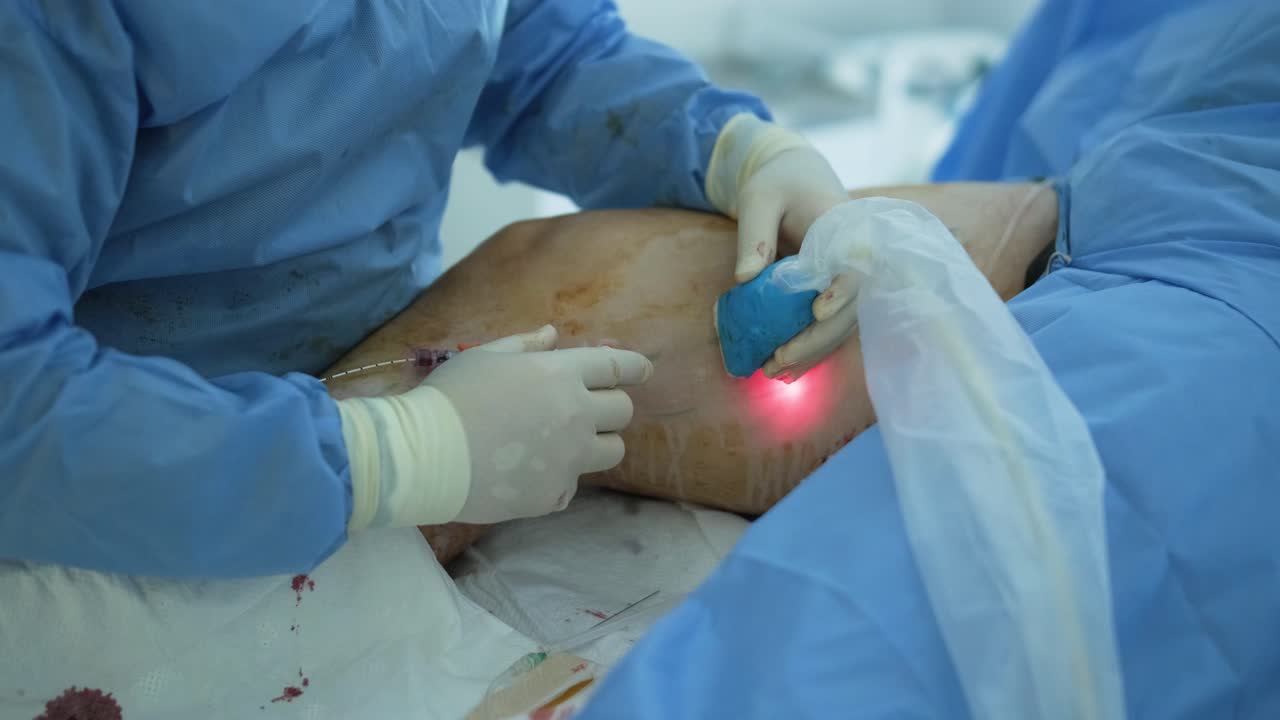 다리 양의 경우, 정맥 경화 치료를 위해 phlebology 절차에서 bioglue를 사용하여 정맥을 결합합니다.