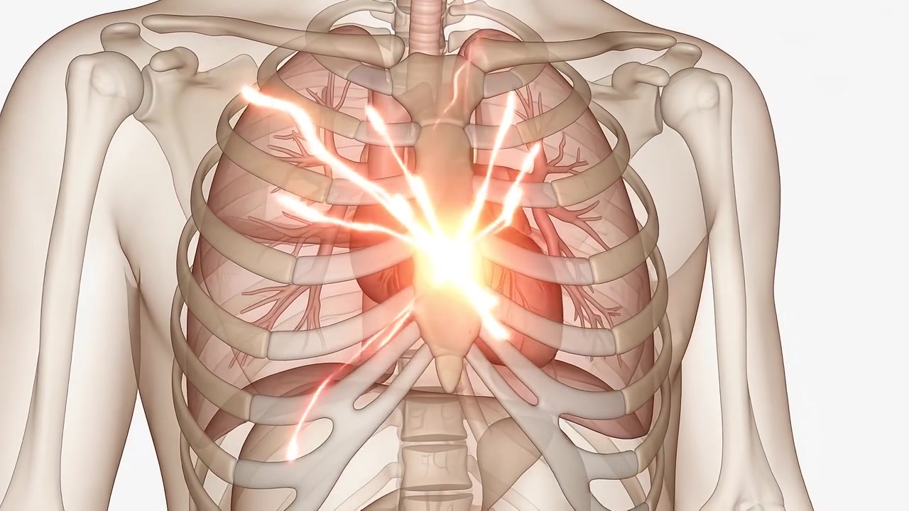 Animazione medica di aritmia cardiaca e impulso elettrico