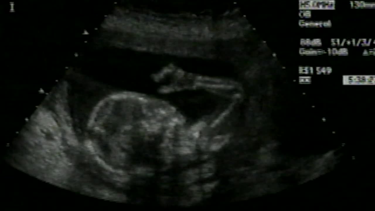 O braço de um bebê é identificado em um ultrassom.