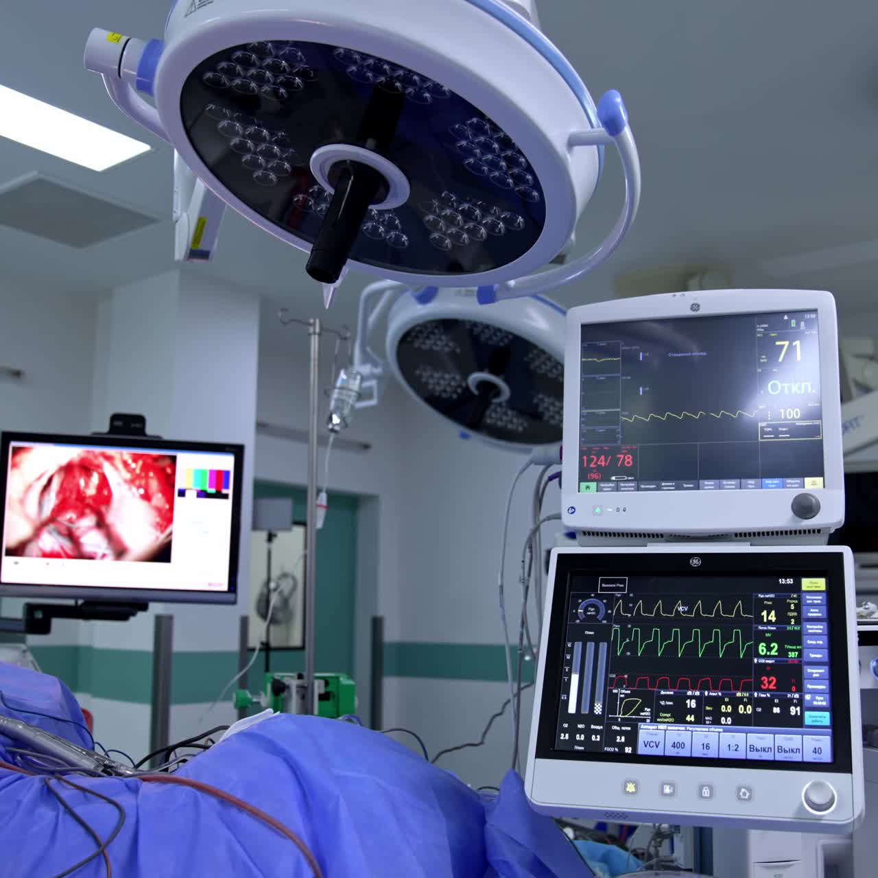 Displaying the operational procedure on the screen in surgery room. Monitors with patient's life parameters are near the operational table