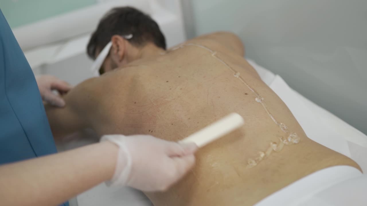 Beautician applying laser hair removal gel on man's back, before laser treatment.
