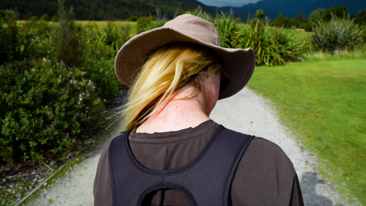 Woman with Severe Sunburn on Her Neck