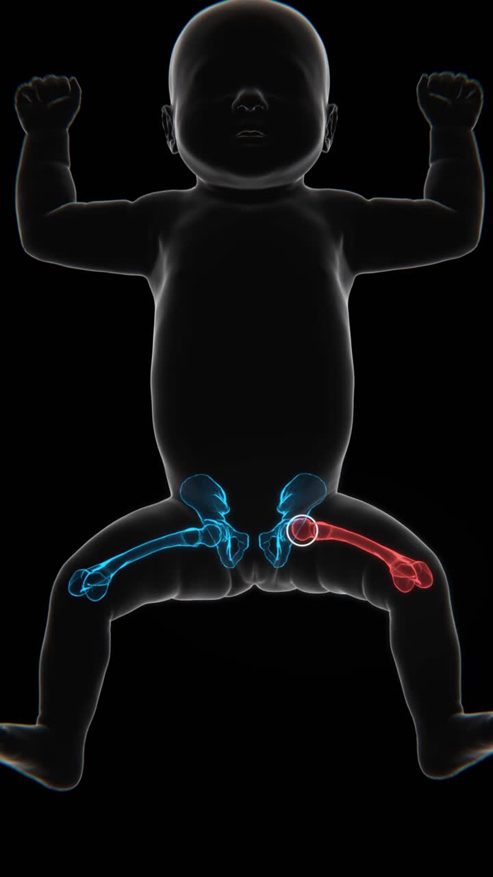 X-Ray video of Hip Dysplasia in new born baby | Hip Dysplasia Video in X-Ray