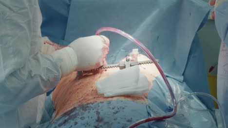 surgeon uses chest tube during surgery. doctor uses specialized equipment for removing air and drain fluid after performing procedure in cavity