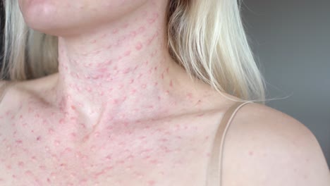 real biorevitalización de la piel sobre un fondo blanco rastros de inyecciones de biorevitalización en el rostro de una mujer rastros de agujas de biorevitalización.