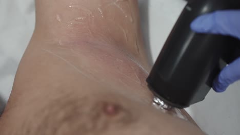 man's armpit laser hair removal in progress