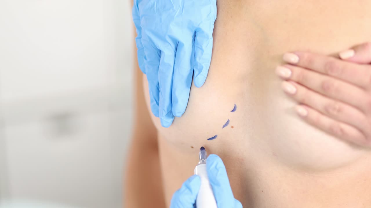 Pre-operative marking for breast surgery or cosmetic procedure