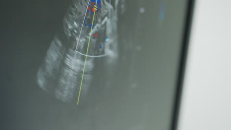 close up of radiography machine screen displaying angular shape wave movement in high resolution during internal imaging analysis with highlighted color-coded areas indicating motion detail