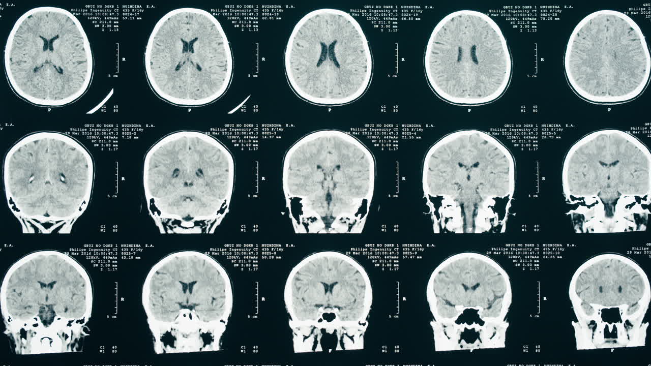 Professionista medico che analizza una scansione TC del cervello umano