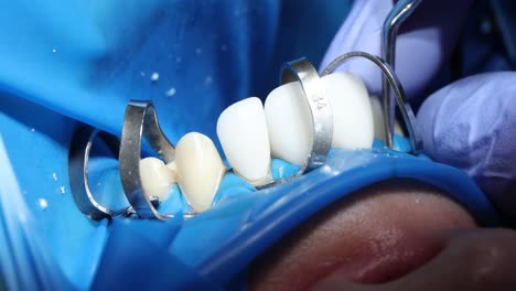 close-up of a dental procedure with a rubber dam and crowns