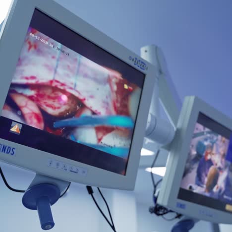 medical monitors show operation. internal organs with medical tool on the display. neurosurgical procedure on screens in the operating room.