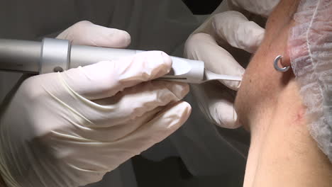 procedimiento de tratamiento cutáneo con láser