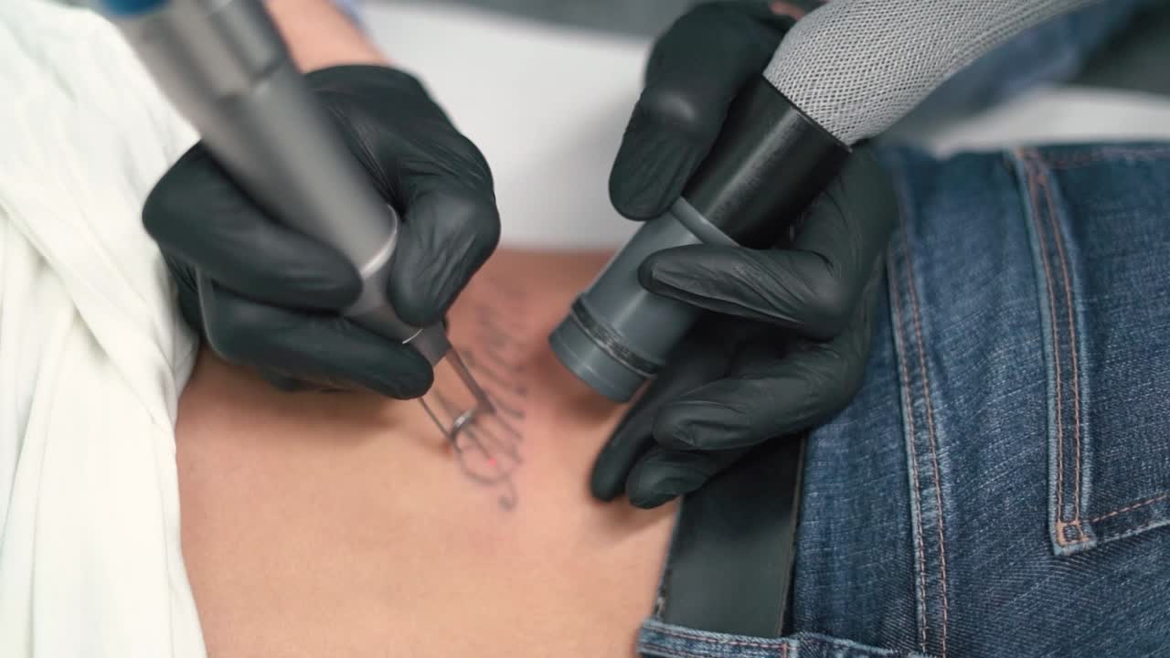 Donna che rimuove un tatuaggio, cancellandolo o eliminandolo