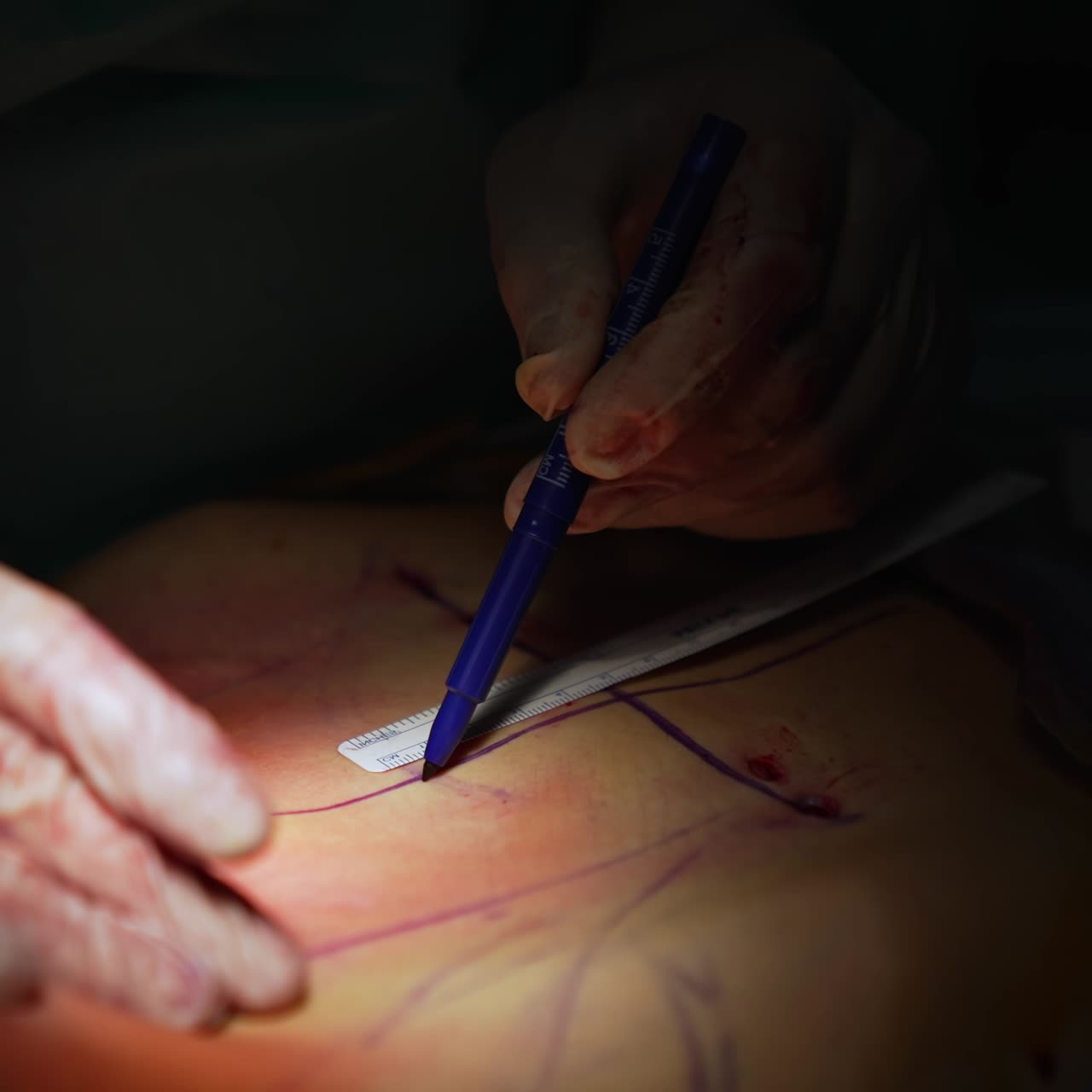 Chirurgo plastico che traccia segni sull'addome prima dell'intervento. Liposuzione addominale. Addome del paziente durante l'operazione. Preparazione per la chirurgia plastica. Primo piano