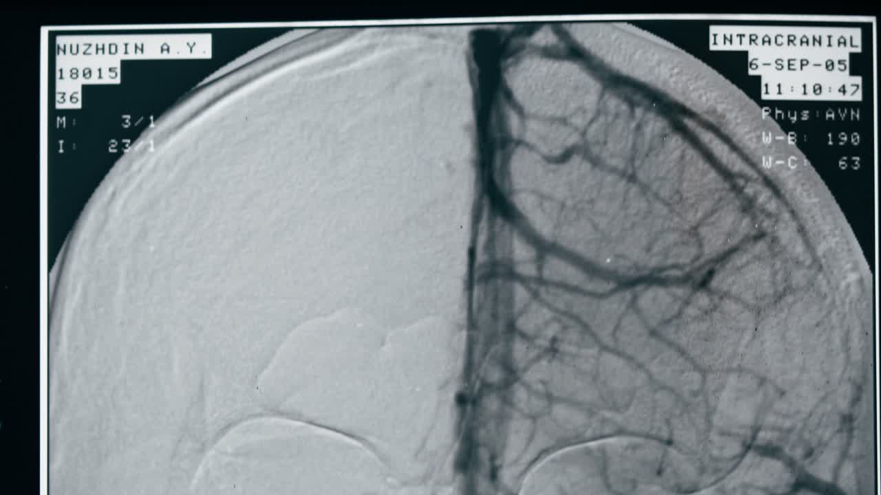 Display digitale di angiografia cerebrale umana.