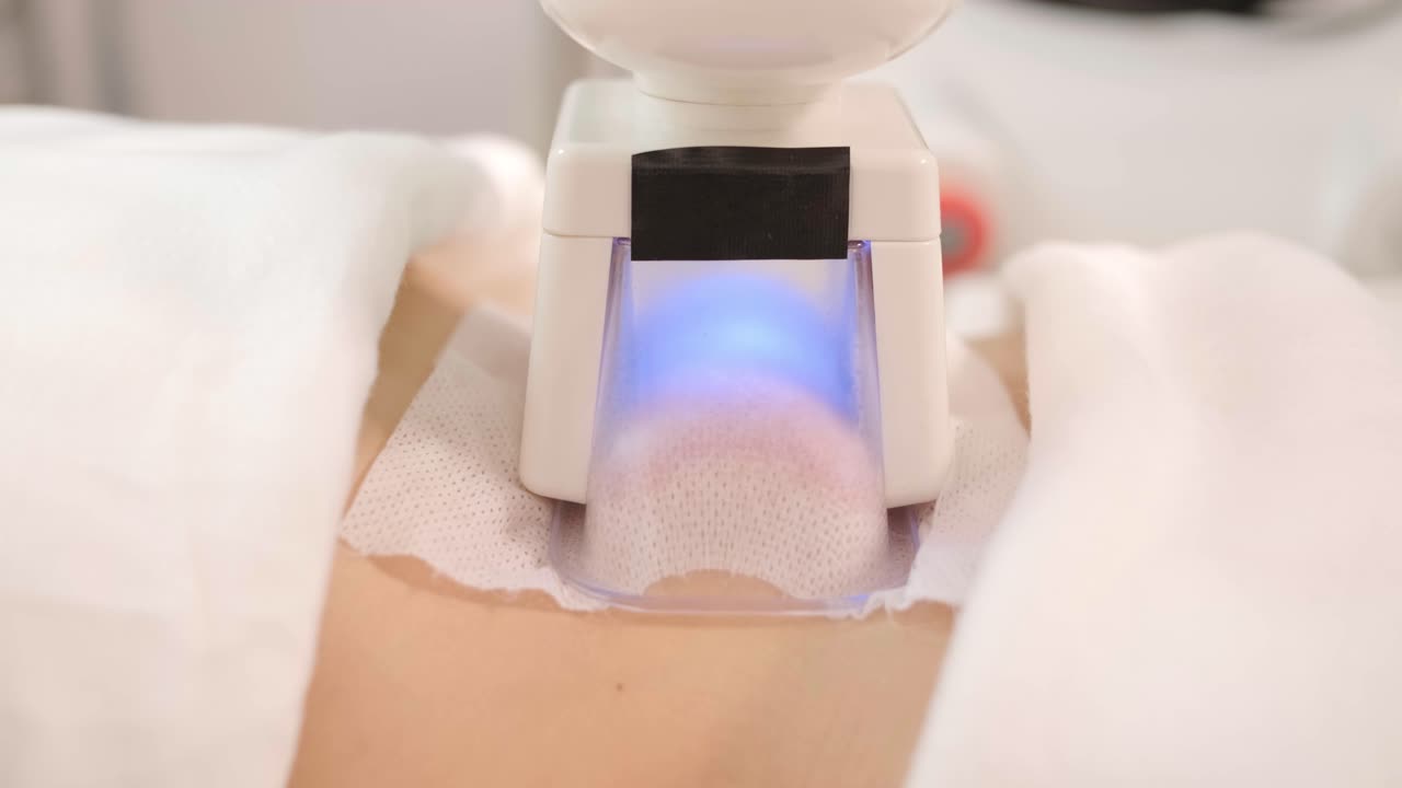 сриолиполиз процедура обработки жира в современной косметологической клинике