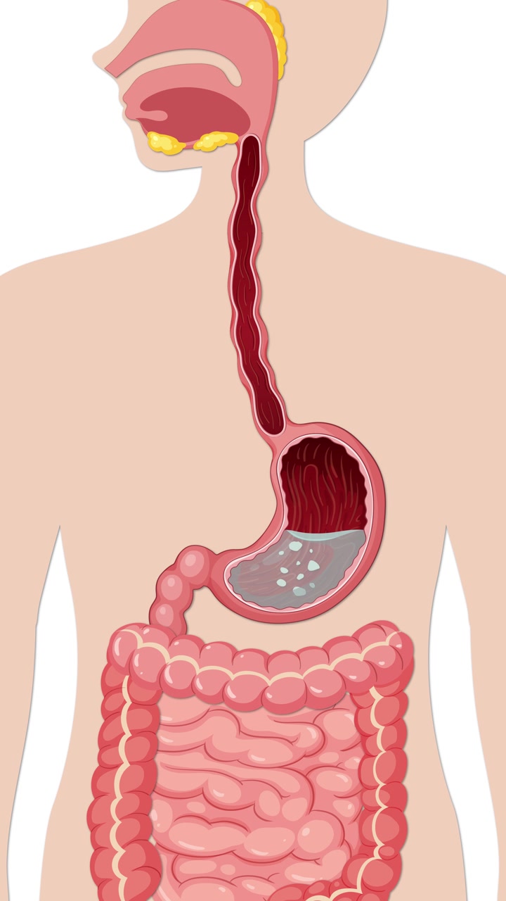 Illustrazione medica verticale che mostra bolle di gas che si formano ed espandono all'interno dello stomaco e dell'intestino umano