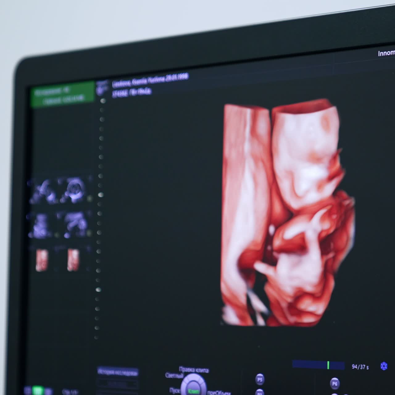 Little unborn child's image on the ultrasound scan. Checking the pregnancy progress in hospital