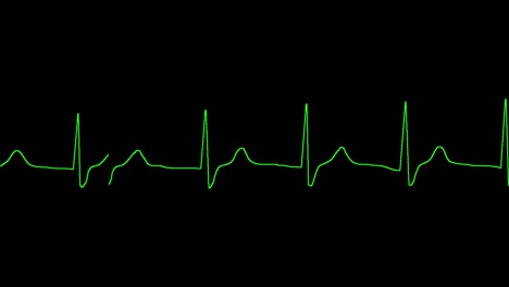 el ecg muestra arritmia del ritmo juncional