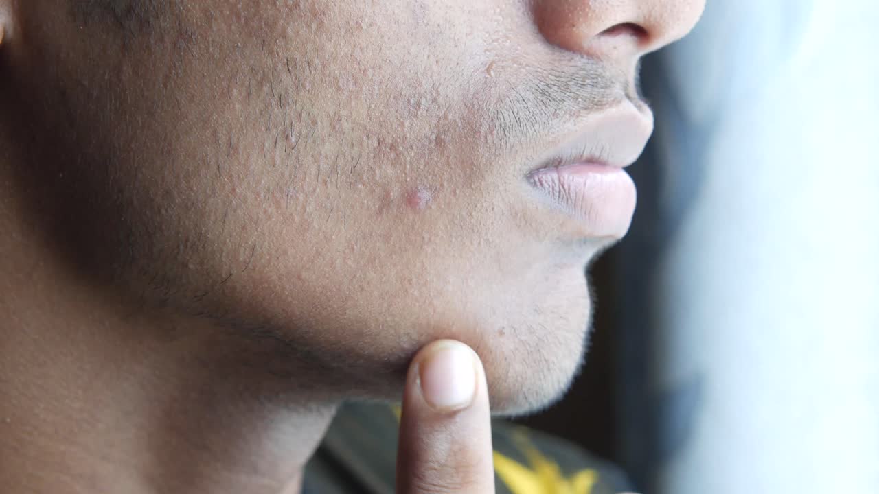 남자의 얼굴에 있는 여드름의 클로즈업