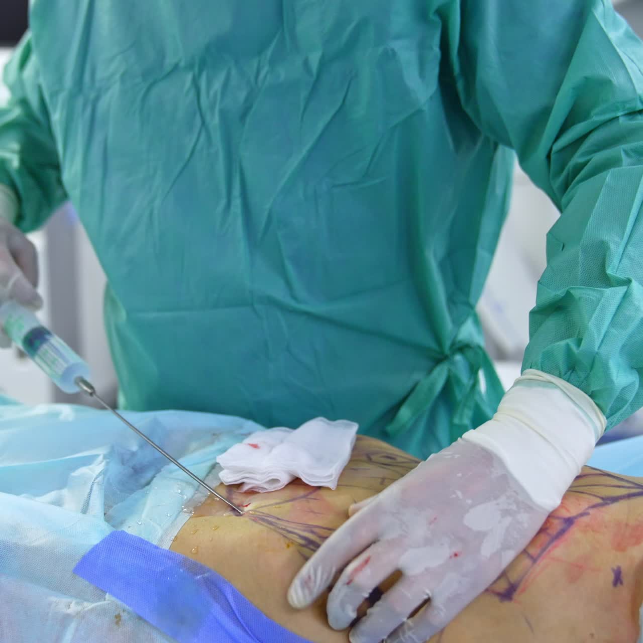 Surgeon's hands in gloves hold the large syringe with transparent substance. Doctor using the instrument to conduct the abdominal liposuction
