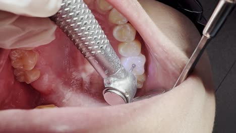 Close-up-shot-of-a-dentist-drilling-a-tooth-to-remove-tooth-cavity