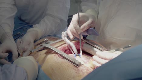 medical staff of the operating unit do heart surgery the nurse assists in performing the operation