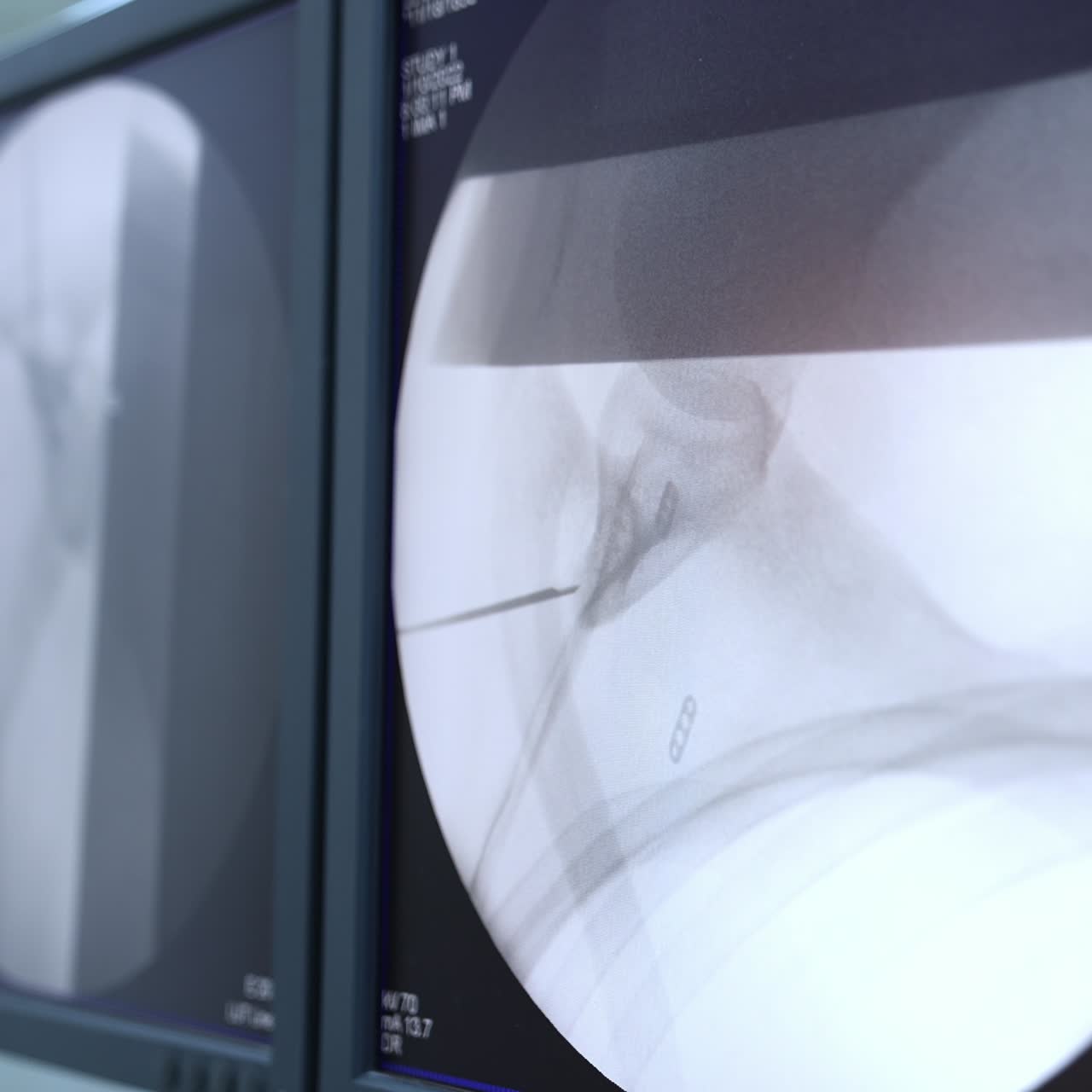 Black screens showing the work of technological tools at surgery. Advanced equipment in modern hospital