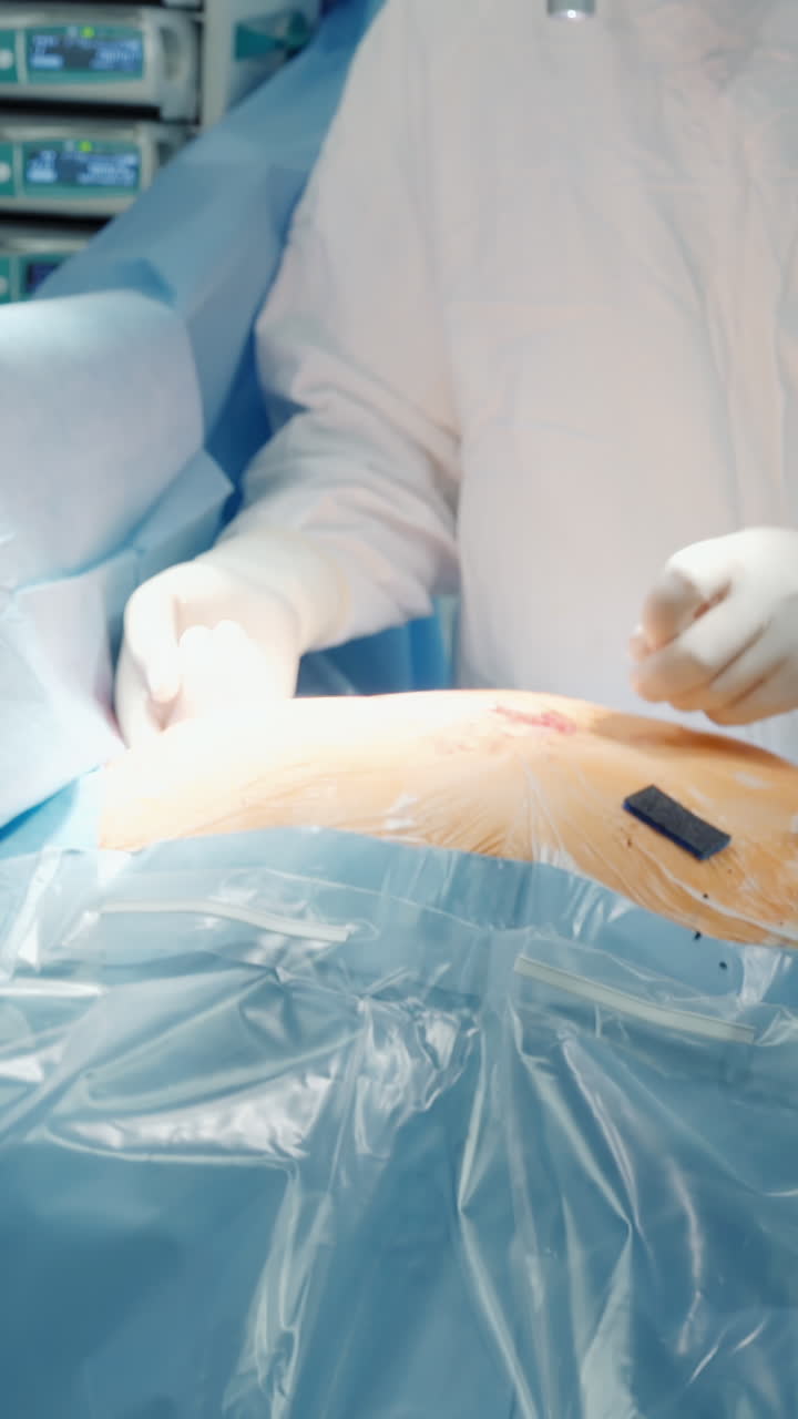 el cirujano corta el hueso del pecho con una sierra esternal. el cirijano abre el acceso al corazón del paciente enfermo para la cirugía de derivación de la arteria coronaria en el hospital. herramienta médica