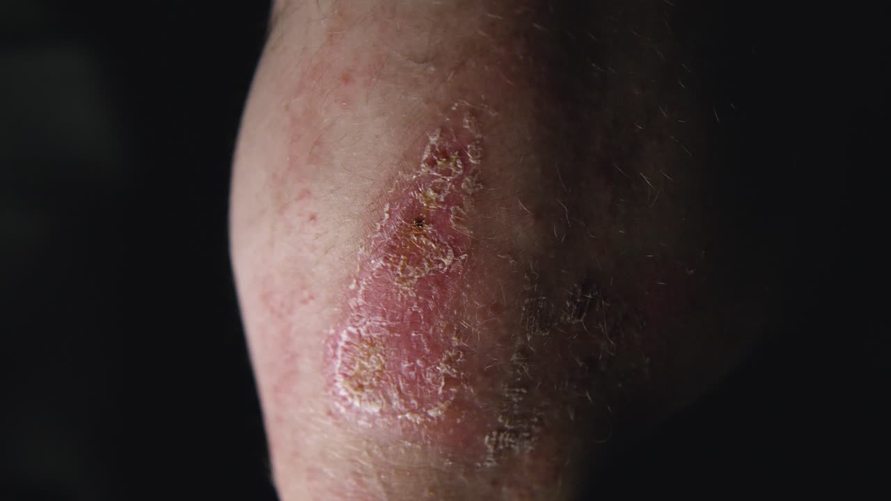 costra seca en el codo