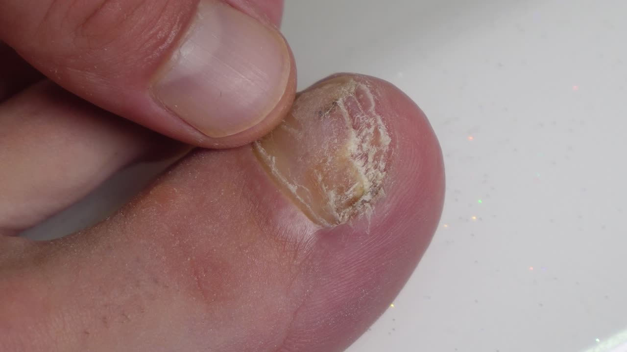 A cracked and discolored toenail caused by mycosis - fingers rub the sore toe