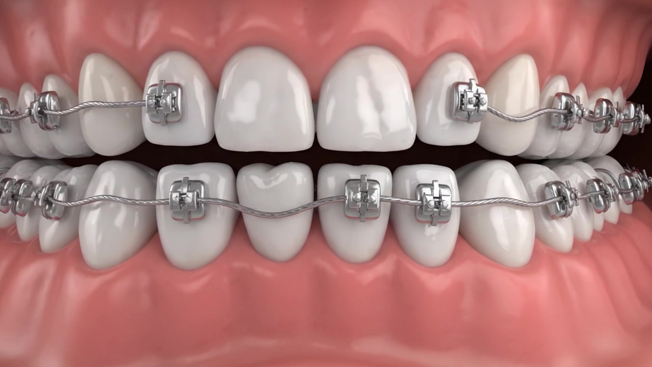 Detailed Examination of Adult Teeth with Braces: Visualizing Alignment Progression and Orthodontic Treatment Effects on Dental Aesthetics