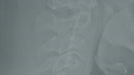 x-ray of cervical spine