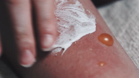 Closeup-Of-Ointment-Applied-To-Painful-Blisters,-Infected-With-Fluid-Discharge