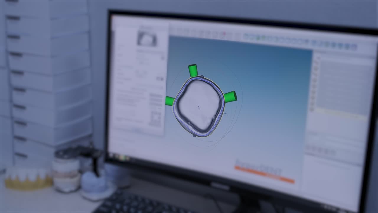 CNC Machine Cutting Zirconia Crowns from Unfired Zirconia