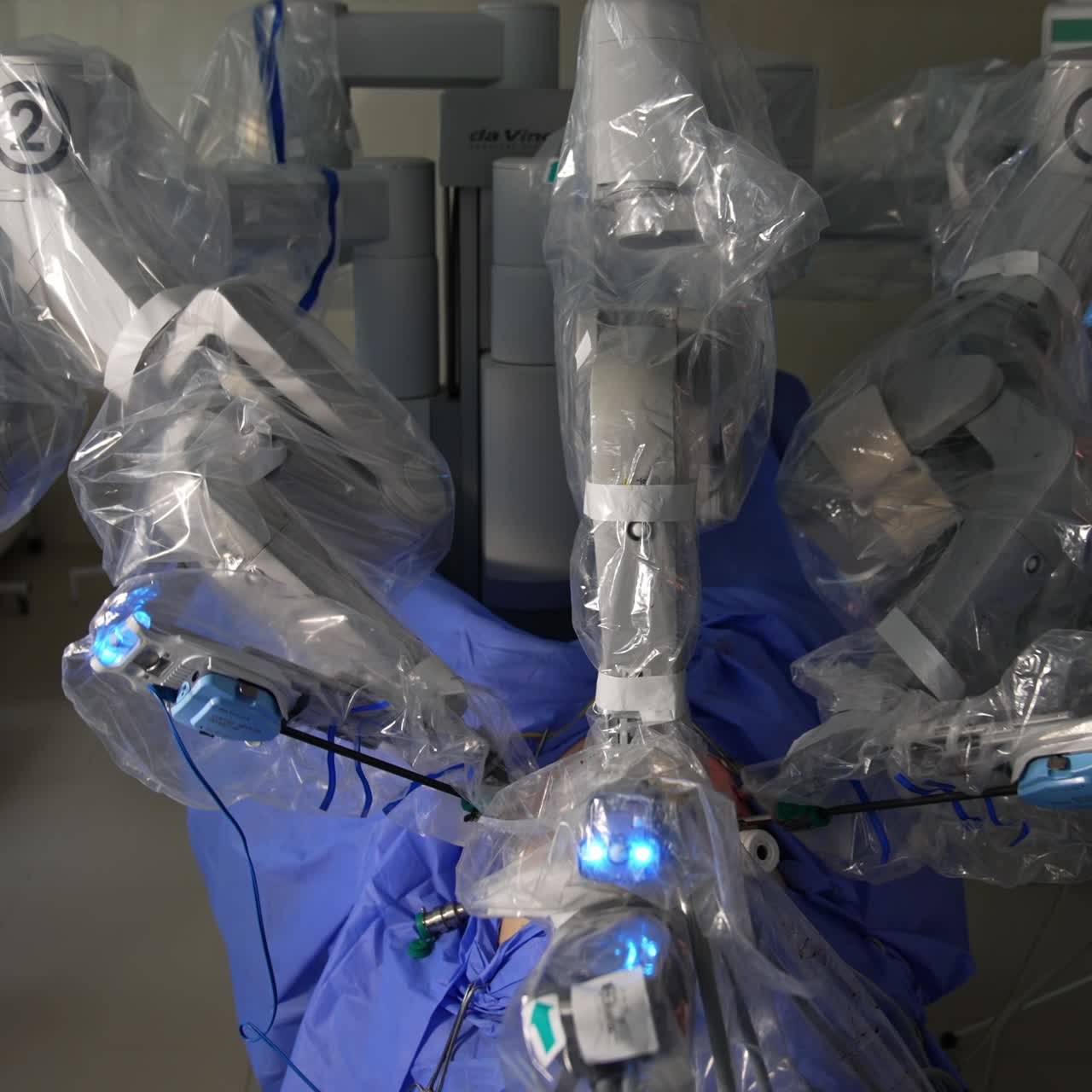 Medical robot operating the patient. Manipulator active arms moving in the abdomen of a person. Vision cart working at backdrop